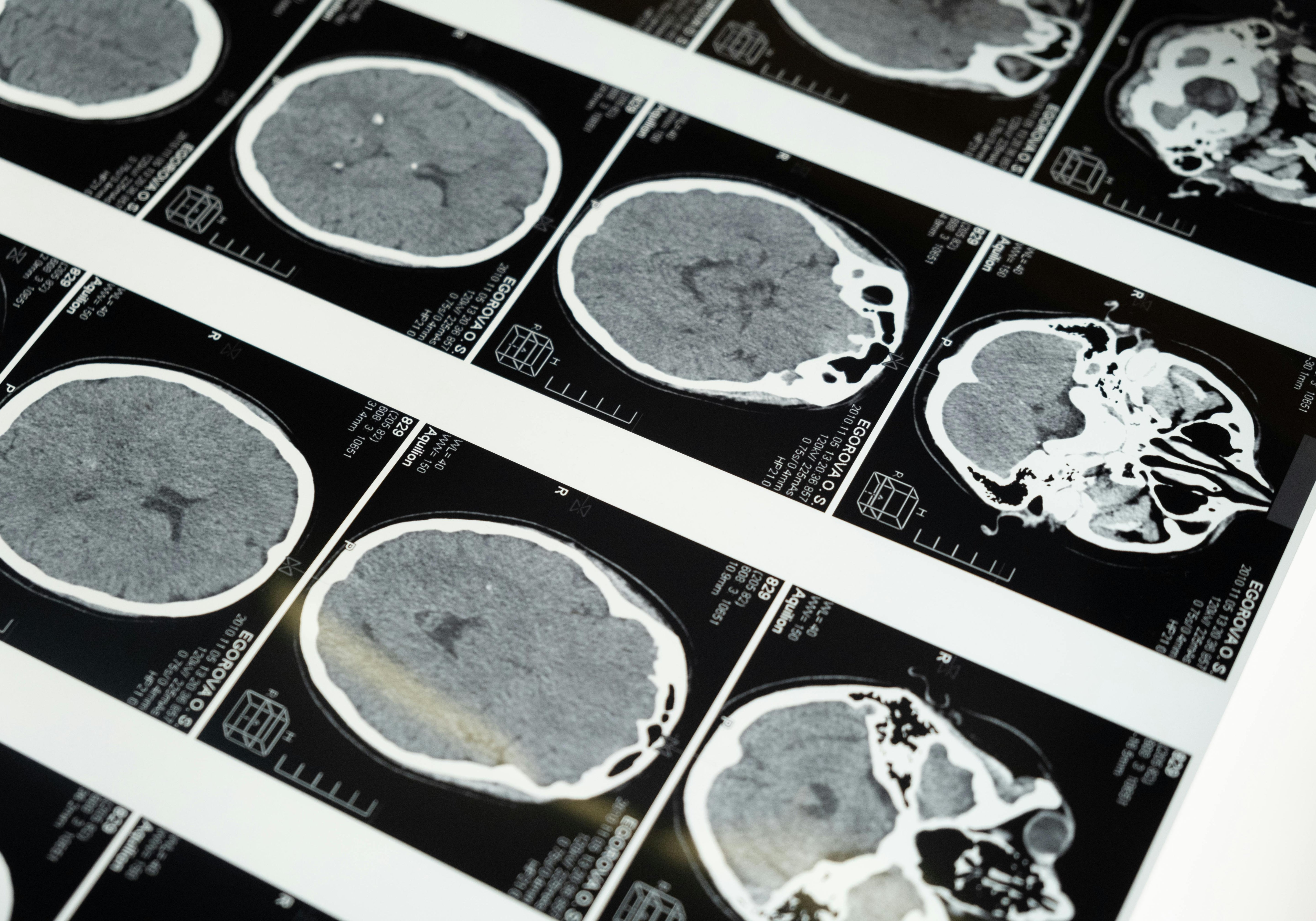 Cognizin Citicolin – Therapeutische Anwendungen und aktuelle Studienlage