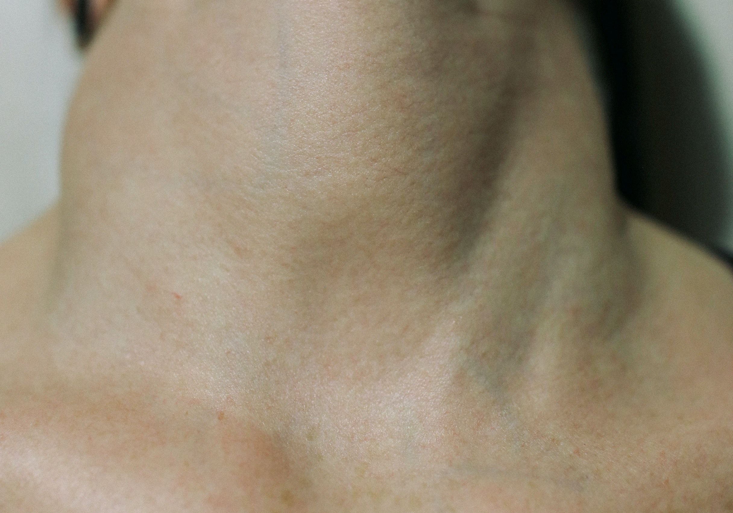 Überfunktion, Unterfunktion, Hashimoto... die Schilddrüse verstehen lernen